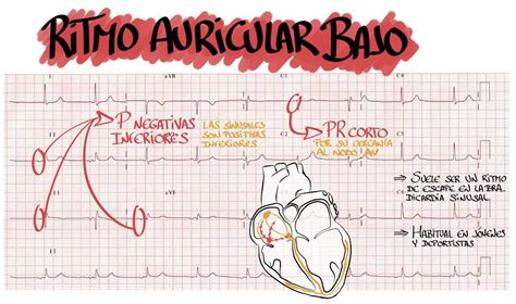 Que Significa Ritmo Sinusal Pr Corto