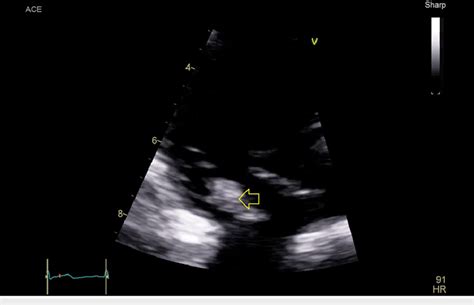 An image of the tricuspid valve of the first transthoracic ...