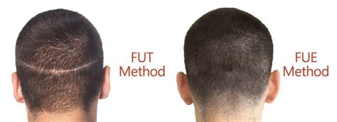 FUE Vs FUT Hair Transplant - SE Hair Clinic - Hair Transplant in ...