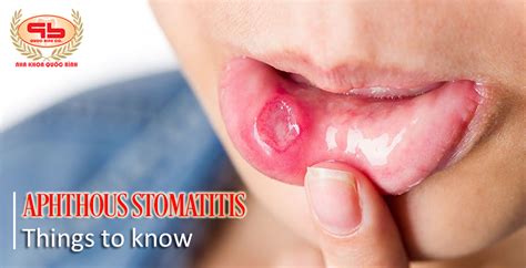 Aphthous stomatitis - things you should know