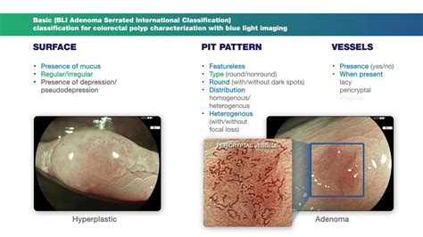 Types Of Colon Polyps Chart