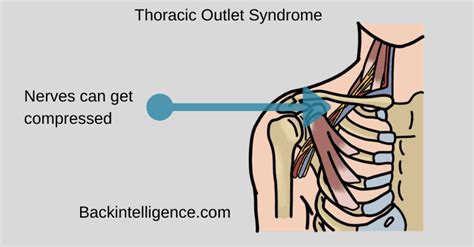 Thoracic Outlet Syndrome Exercises, Causes, Symptoms