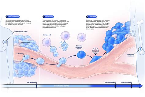 Metastasis: A Roadmap | Memorial Sloan Kettering Cancer Center