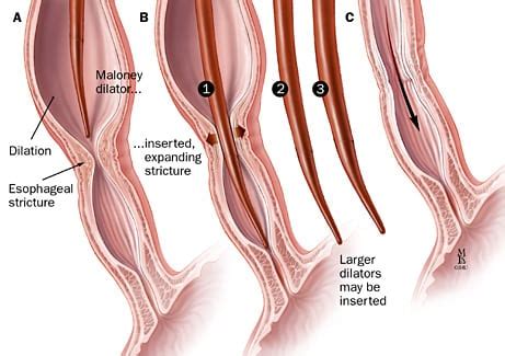 Esophageal Dilatation