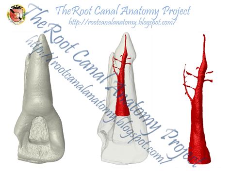 The Root Canal Anatomy Project: Two-Rooted Maxillary Central Incisor