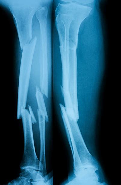 280+ Broken Leg X Ray Stock Photos, Pictures & Royalty-Free Images - iStock