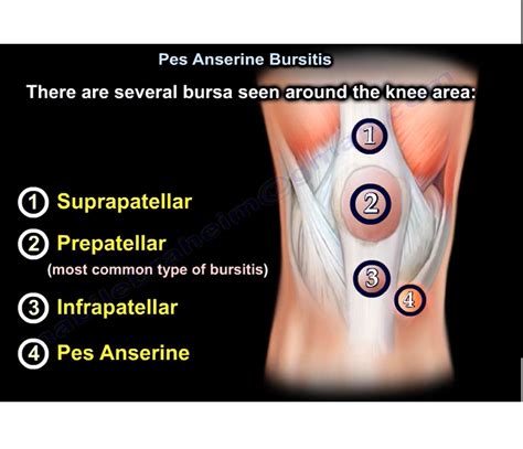 Pes Anserine Bursitis — OrthopaedicPrinciples.com