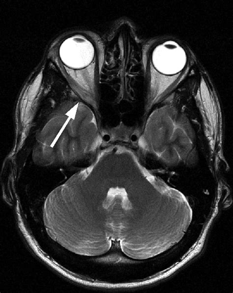 Superior Rectus Palsy