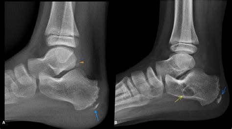 Figure 6 from Calcaneal Apophysitis (Sever´s Disease) a Poorly ...