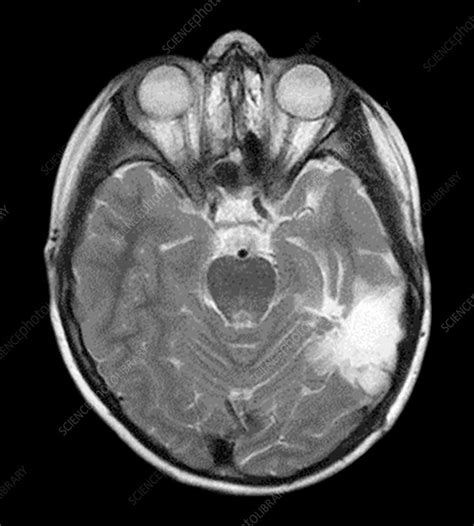 Pleomorphic xanthoastrocytoma, MRI scan - Stock Image - C037/3079 ...