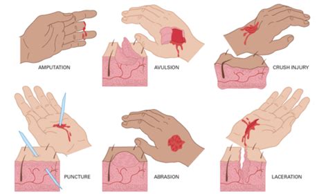 Trauma: Soft tissue Flashcards | Quizlet