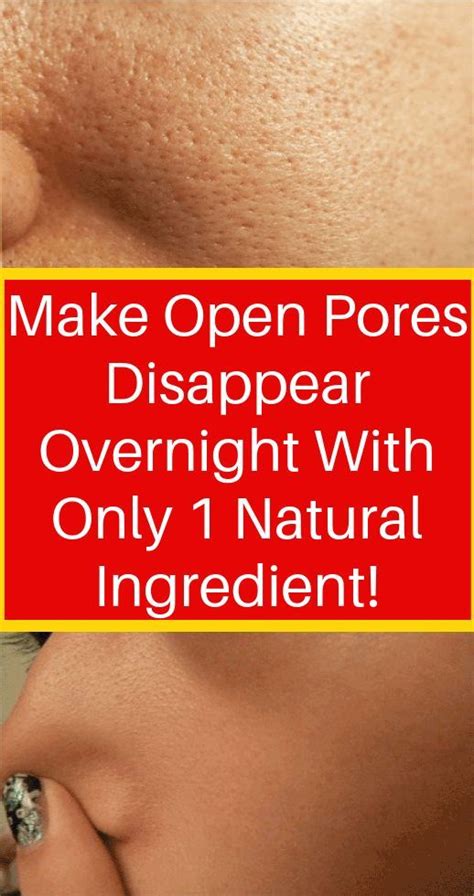 Get Rid Of Open Pores Naturally In Just 3 Days With These Powerful Home ...