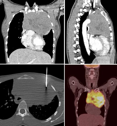 Anterior mediastinal mass - Radiology at St. Vincent's University Hospital