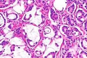 Mucinous carcinoma - Libre Pathology