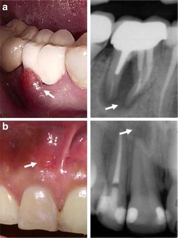 Single-visit endodontic treatment of mature teeth with chronic apical ...