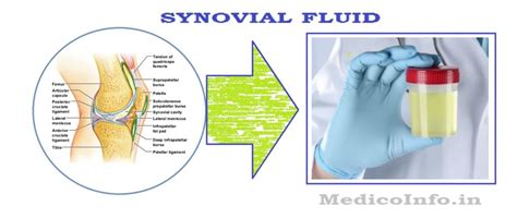 Synovial Fluid Collection & Analysis : Significance, Collection ...