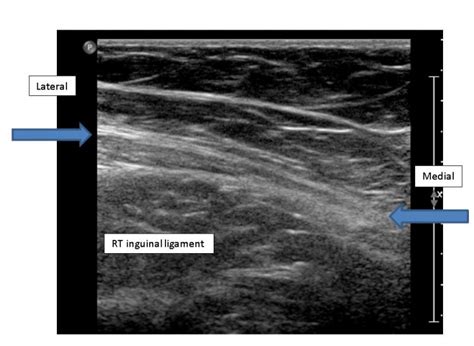 Inguinal Hernia On Ultrasound | Images and Photos finder