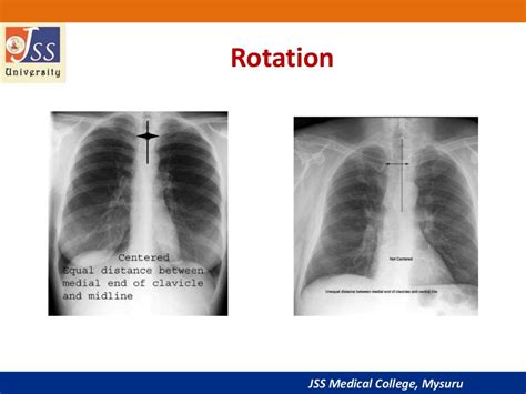 Chest x ray basic interpretation