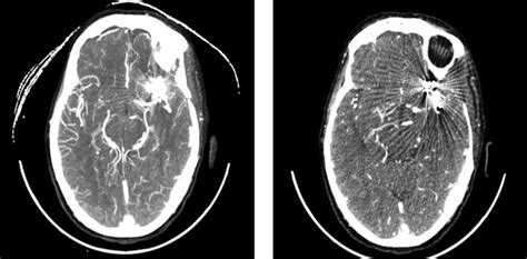 Cerebral Aneurysm Ct