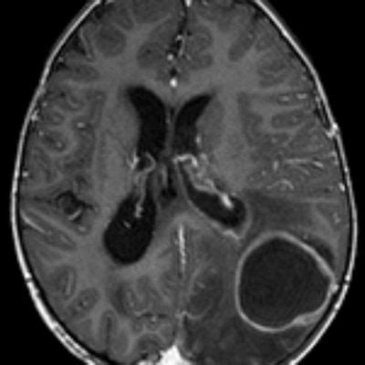 Brain Abscess : Causes, Symptoms & Treatment | Sanjay Hospital