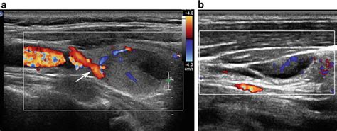 Normal Thyroid Appearance and Anatomic Landmarks in Neck Ultrasound ...