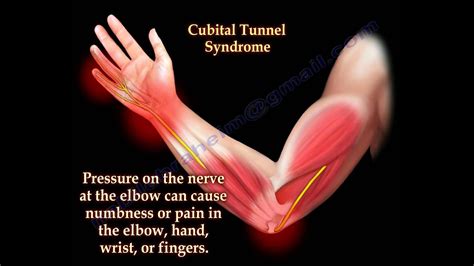 Cubital Tunnel Syndrome - Carolina Regional Orthopedics