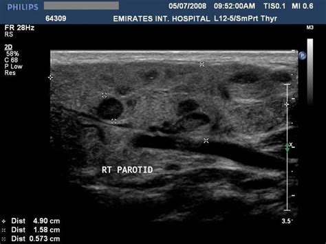 parotitis | Salivary gland, Ultrasound, Glands