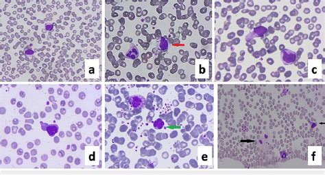 Peripheral blood smear showing various changes in lymphocyte a ...