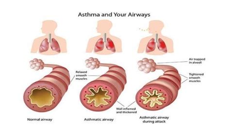 pathophysiology of asthma and COPD