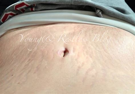 :: Young And Restless ::: Tummy Tuck 4 Month Update! {VENT SESSION}