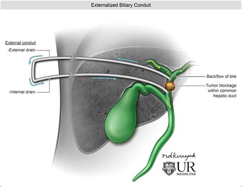 Bilateral Biliary Drainage - Best Drain Photos Primagem.Org