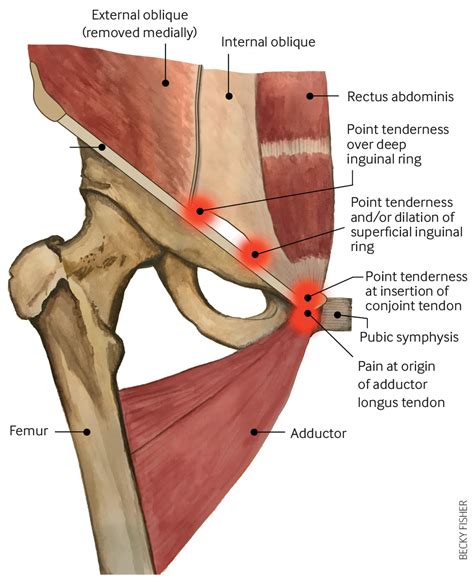 Common Causes of Groin Pain: When to Seek Chiropractic Care | Hyperhealth