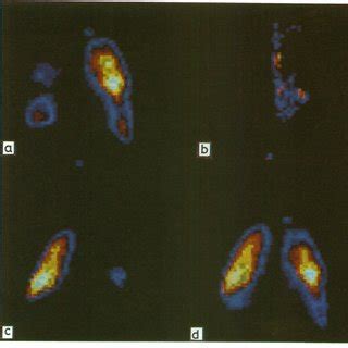 Figure Radionuclide anterior images in case 3: (a) image after ...