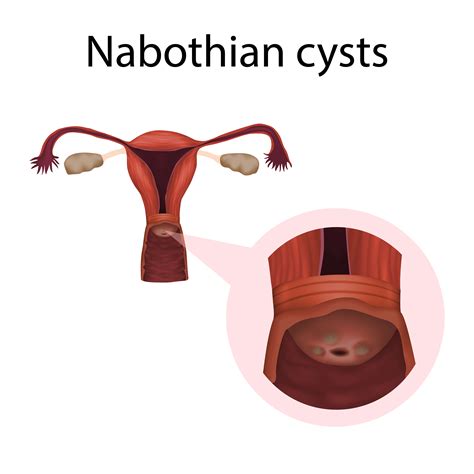 CME Activity | Nabothian Cyst | MDs & PAs