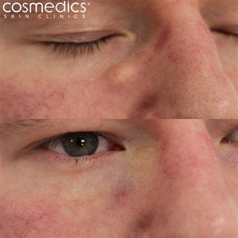 Cyst Removal London Surgical Treatment | Cosmedics Skin Clinics