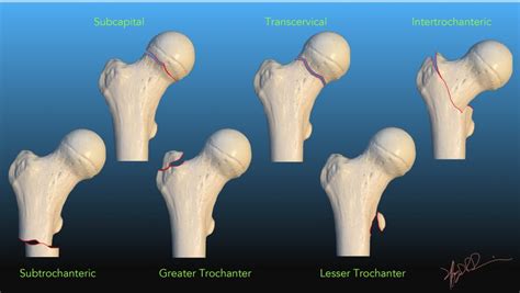 Femoral Neck Fracture Nomenclature | UW Emergency Radiology