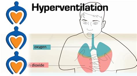 Sindrome De Hiperventilacion