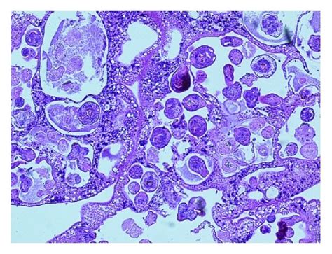 H&E stain of hydatid cyst contents demonstrating numerous scolices ...