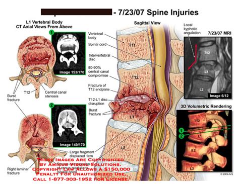 AMICUS Illustration of amicus,injury,spine,ct,L1,vertebrae,burst ...