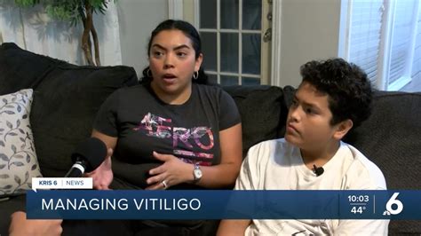 Younger children with vitiligo will benefit from newly approved treatment