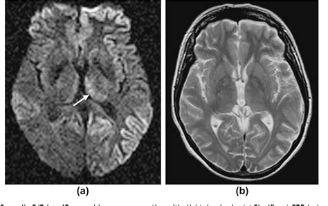 Figure 4 from Differential diagnosis of restricted diffusion confined ...