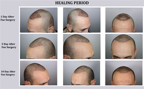 Fue Hair Transplant Technique