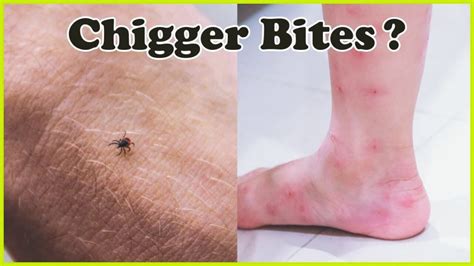 How to get rid of chiggers? – x-pest