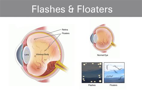 Flashes and Floaters | Pediatric Family Eyecare