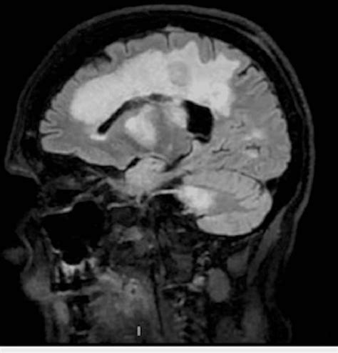 Sagittal view of MRI T2 FLAIR sequence of the lesions FLAIR ...