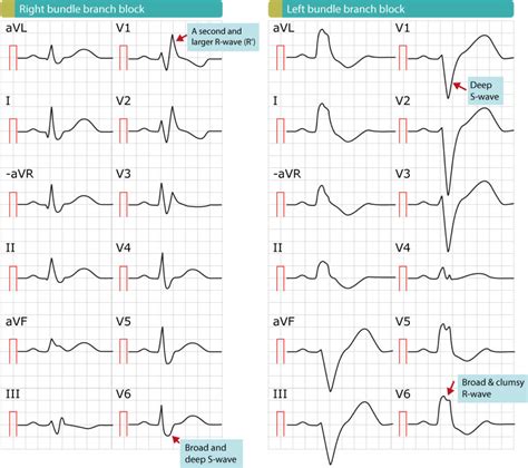 Bloqueo De Rama Derecha Brd Ecg Criterios Definiciones Causas Y ...