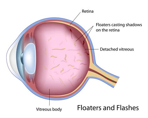 Posterior Vitreous Detachment - Discovery Eye Foundation