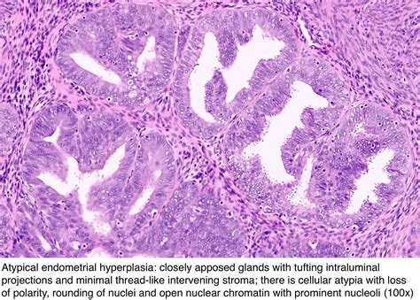 Pathology Outlines - Endometrial hyperplasia / endometrioid ...