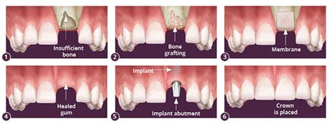 Brooklyn Bone Grafts | Dental Bone Grafting in Brooklyn NY