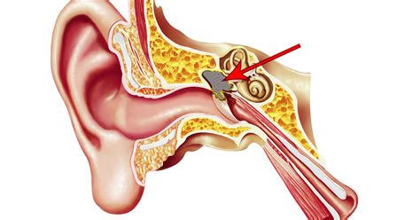 Cholesteatoma - Alabama Nasal and Sinus Center, Birmingham, AL, ENT